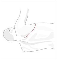 Toracotomia (Common cardiothoracic incisions)