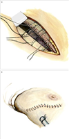 Toracotomia (Common cardiothoracic incisions)