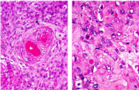 Well-differentiated squamous cell carcinoma