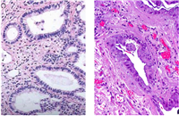 Adenocarcinoma