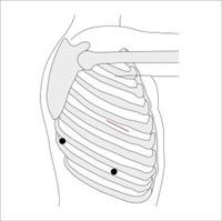 Video-assisted thoracoscopic surgery (VATS)